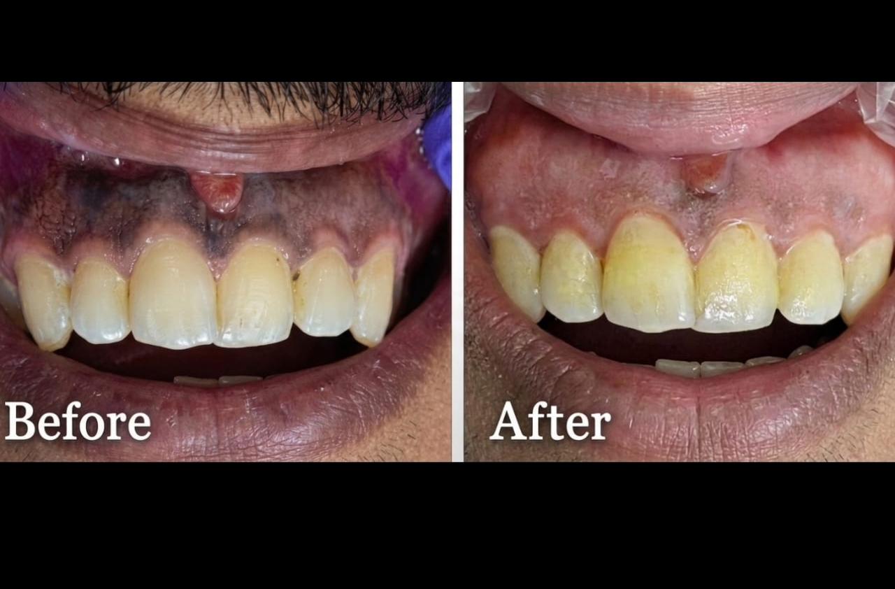 After Treatment